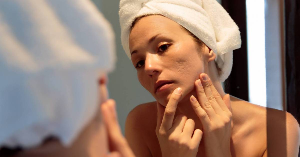 How to better manage your acne breakouts | Georgia Straight Vancouver's  News & Entertainment Weekly